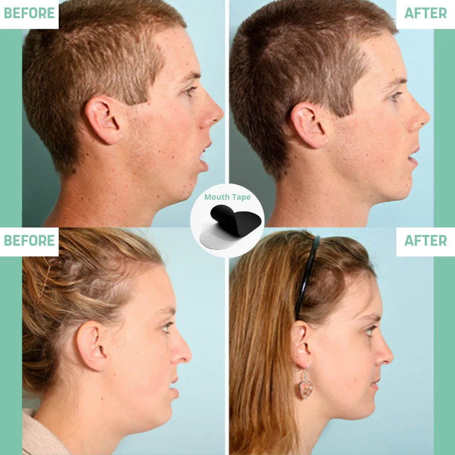 Anti Snoring Mouth Tape (30 Day Supply)